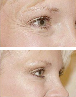 Wrinkle treatment Vitality Medi-Spa Halifax NS